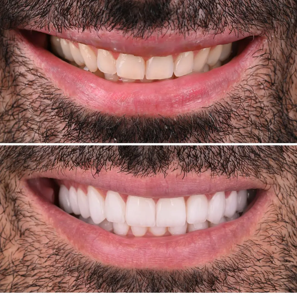 VENEERS