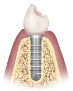 dental implant