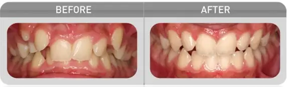 Myobrace_Treatment_Crowding