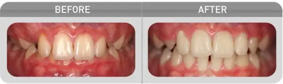 Myobrace_Treatment_Deep_Bite