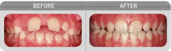 Myobrace_Treatment_Open_Bite