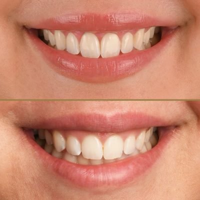 crown lengthening